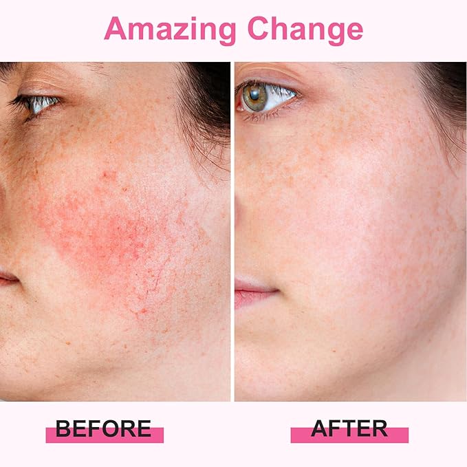 Ice Roller for Face Body, Hot Roller Ice Rollers, Facial Roller Skin Care Tool for De-puffing Soothing Face for All Skin Types, Premium Silicone Handle, Gift for Women Girls, Pink, 1 PCS