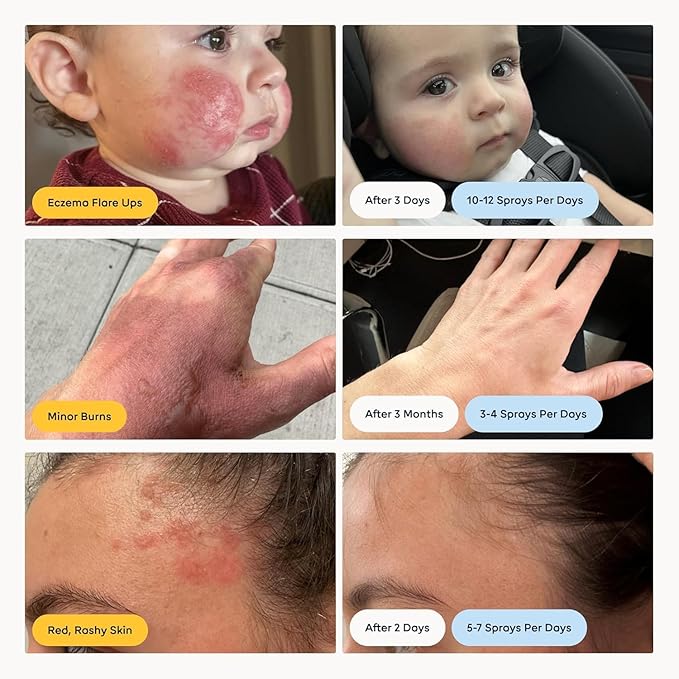 Magic Molecule Skin Cleanser for All Types, Hypochlorous Acid Spray Helps Heal Acne Prone, Eczema and Itchy Rashes and 50 Other Skin Ailments, 3.4 oz Spray (Pack of 2), Travel-Friendly