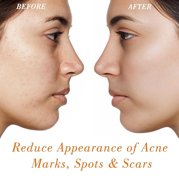 Rosehip Seed Oil for Face (2 oz/60 ml) USDA Certified Organic 100% Pure Natural Cold Pressed Unrefined Rosehip Oil for Skin Anti-Aging, Scar, Hair Moisturizer, Gua Sha Massage, Nails