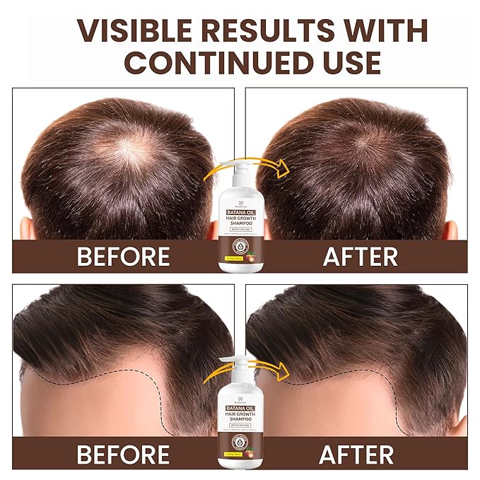 Batana Oil Hair Growth Shampoo: Natural Hair Loss Shampoo for Thinning Hair for Women and Men - Daily Hair Care at Home - 10.1 fl.oz